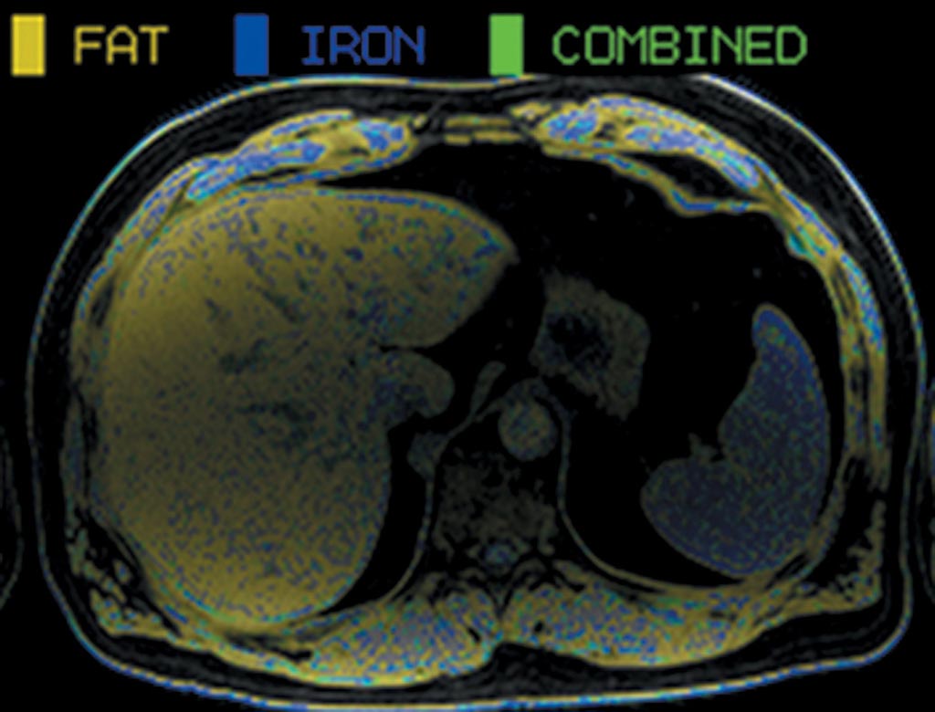 Imagen: Un ejemplo de una resonancia magnética en un donante vivo potencial de hígado que muestra la esteatosis hepática (amarillo) del hígado entero (Fotografía cortesía de la Universidad de Toronto).