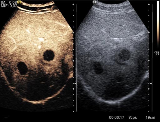 Imagen: Un nuevo estudio sugiere que el ultrasonido con contraste mejorado (L) proporciona una buena ayuda para el diagnóstico (Fotografía cortesía de radiopaedia.org).