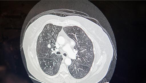 Imagen: La imagen muestra una tomografía computarizada de dosis baja (LDCT) de cáncer de pulmón (Fotografía cortesía de Siemens Healthineers).