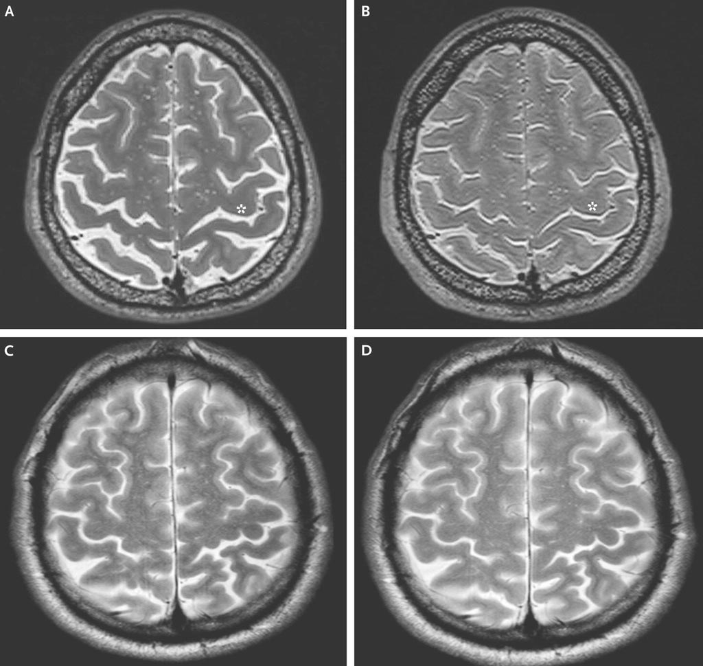 Imagen: Imágenes de resonancia magnética el cerebro tomadas antes (A) y después (B) de vuelos espaciales de larga duración y de corta duración (C y D) (Fotografía cortesía del NEJM).