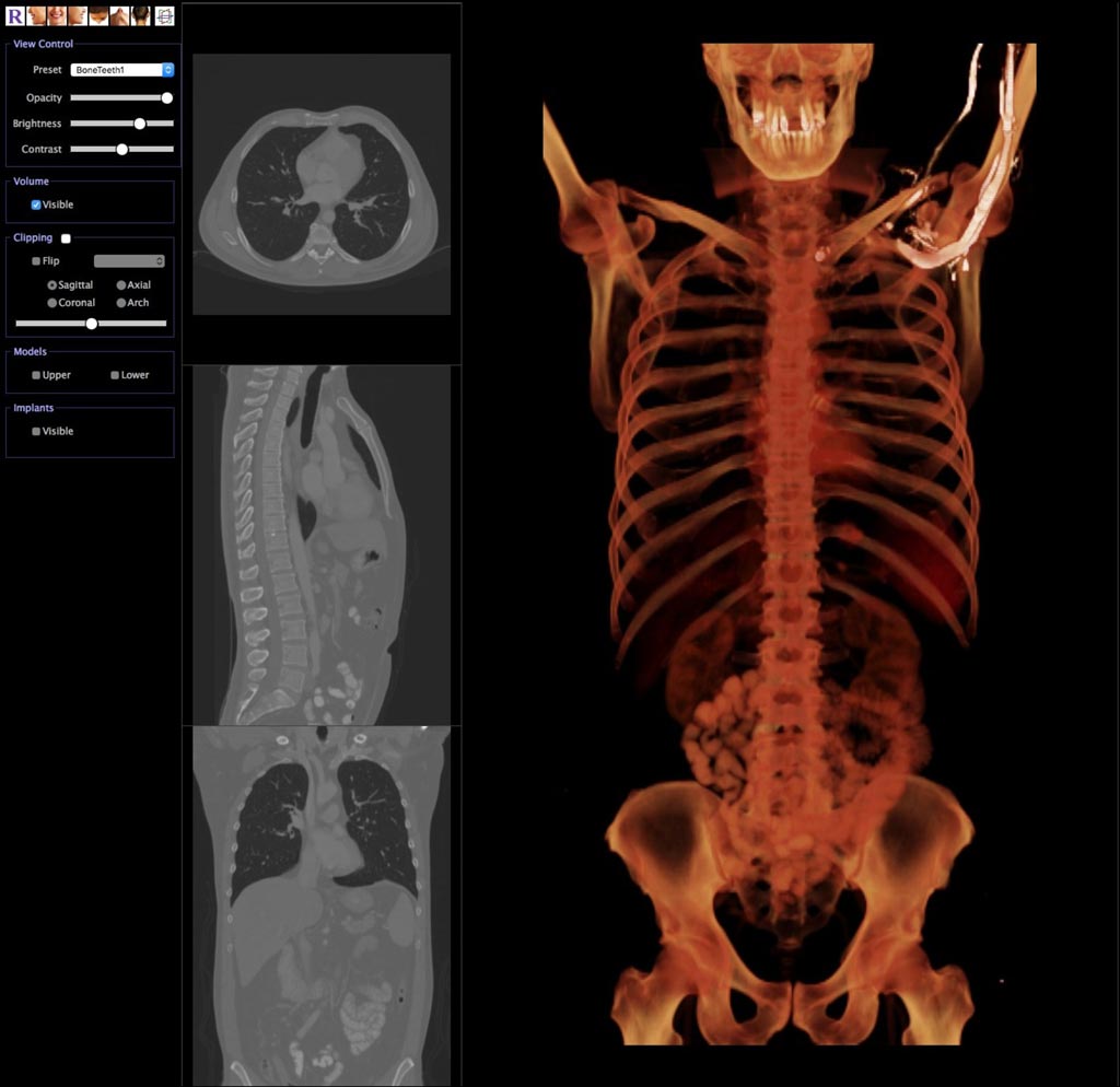 Imagen: Un examen de TC en 3D visualizado a través de la plataforma Anatomage Cloud (Fotografía cortesía de Anatomage).