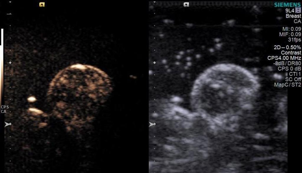 Imagen: Un tumor de mama redondo con microburbujas de oxígeno diseminadas por todo el tumor (Fotografía cortesía de John Eisenbrey / TJU).