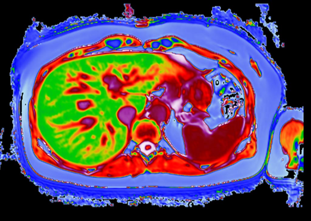 Imagen: Una imagen LiverMultiScan de un hígado posbariátrico (Fotografía cortesía de Perspectum Diagnostics).