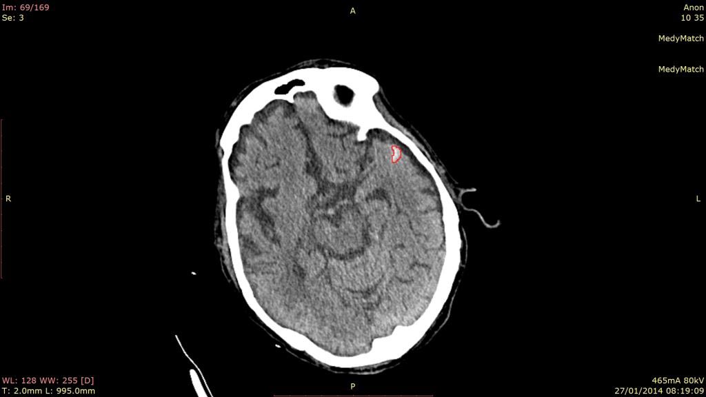 Imagen: Identificación de una HIC identificado en una TC como una ayuda para la evaluación del accidente cerebrovascular (Fotografía cortesía de MedyMatch).