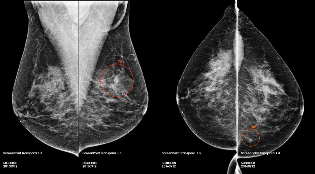 Imagen: Una captura de pantalla del software de lectura de mamografía Transpara (Fotografía cortesía de ScreenPoint Medical).
