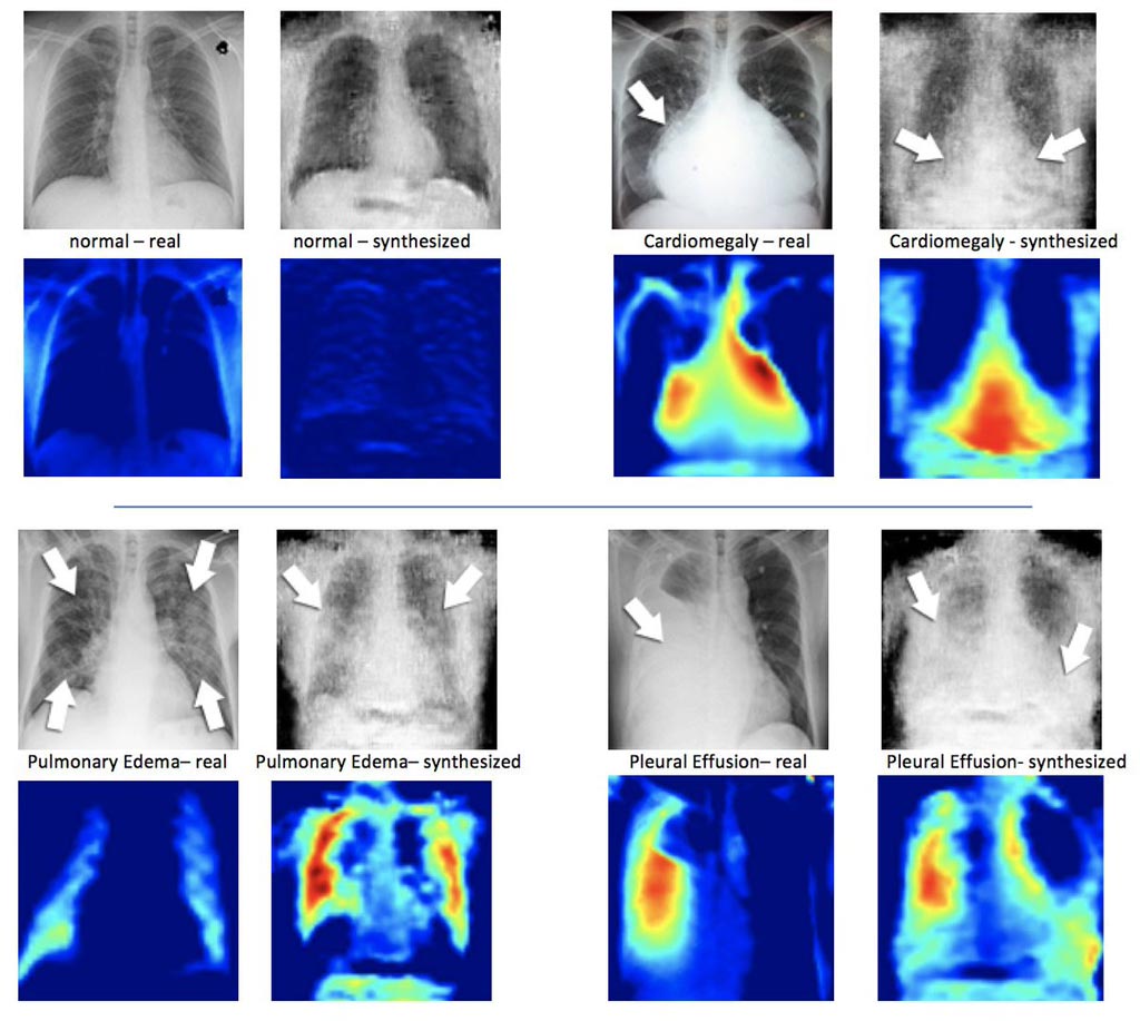Imagen: Rayos X (I) junto a una radiografía sintetizada creada por DCGAN. Debajo de las imágenes de rayos X se encuentran los mapas de calor correspondientes (Fotografía cortesía de Hojjat Salehinejad/MIMLab).