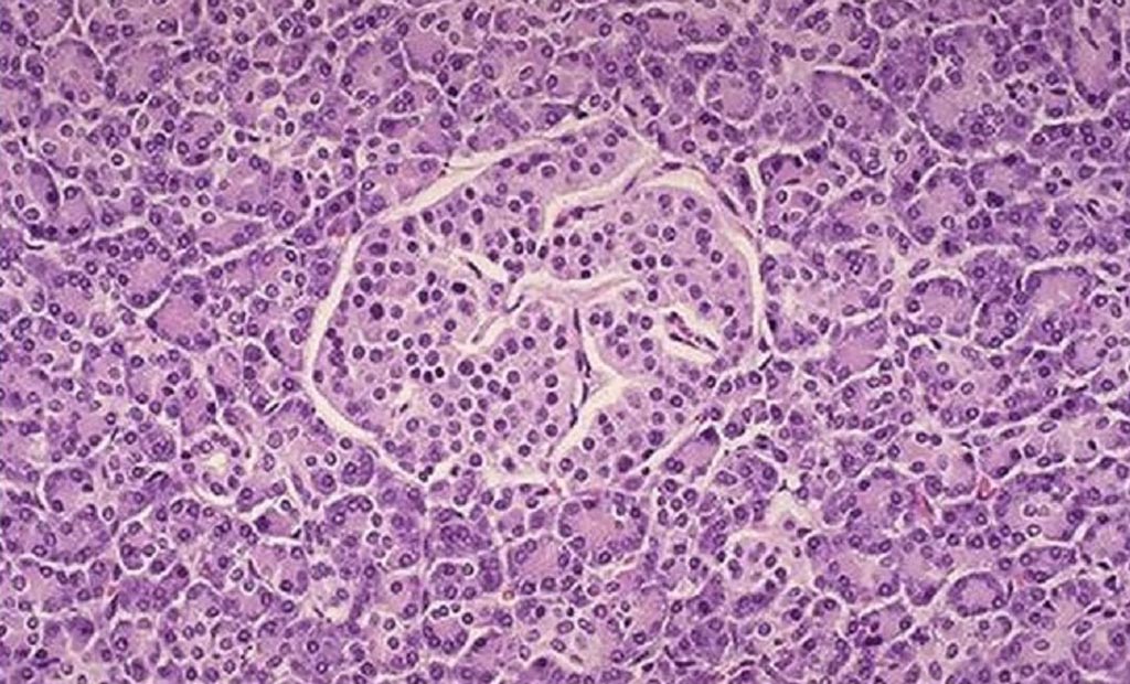 diabetes tipo 1 páncreas ultrasonido patología diabetes tipo 1 páncreas ultrasonido patología