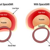 Imagen: El sistema SpaceOAR protege los tejidos circundantes durante la RT de próstata (Fotografía cortesía de Augmenix).