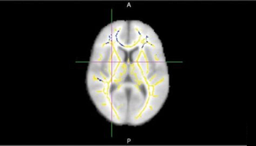 Imagen: La DTI-MRI que muestra áreas de anisotropía fraccional reducida indicando daño cerebral en la materia blanca (Fotografía cortesía de Cyrus Raji / RSNA).