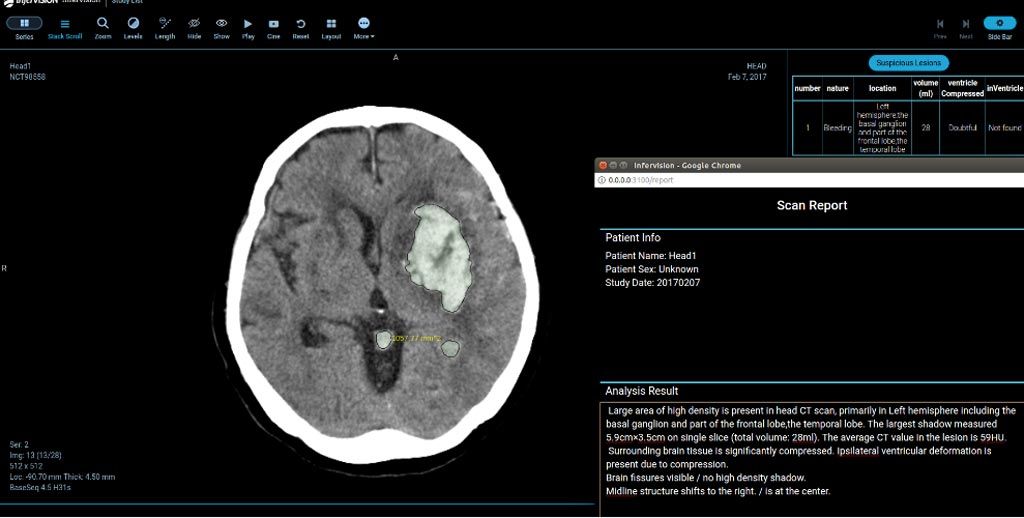 Imagen: El sistema de detección de accidentes cerebrovasculares AI-CT diseñado para ayudar a los radiólogos a detectar y diagnosticar los accidentes cerebrovasculares más rápido que nunca (Fotografía cortesía de Infervision).
