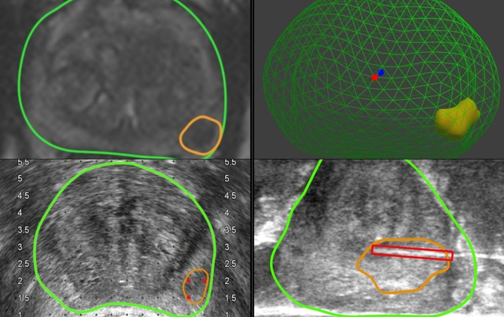 Imagen: Un software que sobrepone la información tumoral de los exámenes de resonancia magnética sobre las imágenes de ultrasonido puede ayudar a los cirujanos a realizar biopsias y mejorar la detección del cáncer de próstata (Fotografía cortesía de UCL).