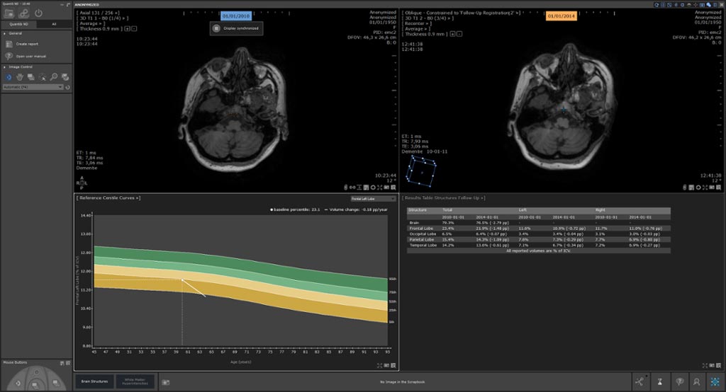 Imagen: El software Quantib Neurodegenerative (ND) que ayuda a los radiólogos a leer los exámenes de resonancia magnética del cerebro recibió la aprobación de la FDA de los EUA (Fotografía cortesía de Quantib).