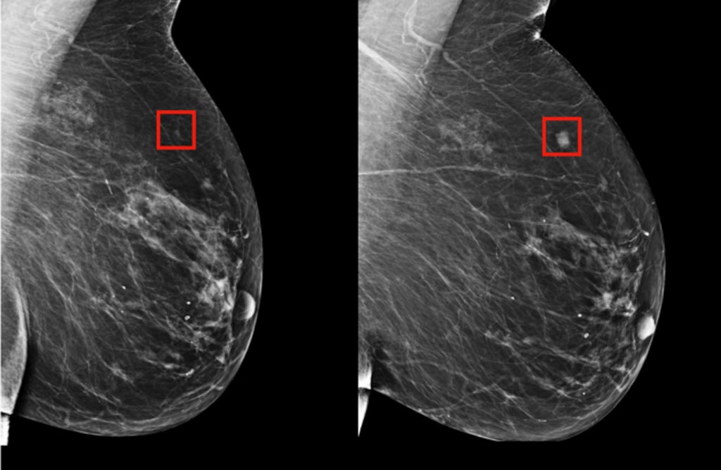 Imagen: Se espera que un método nuevo de inteligencia artificial, para detectar el cáncer de mama, supere los métodos existentes que no cumplen con sus predicciones (Fotografía cortesía del MIT).