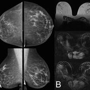 Imagen: Una mamografía (A) comparada con una resonancia magnética de la mama (B) (Fotografía cortesía de MedUni).