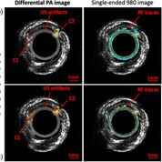 Imagen: El radar fotoacústico utiliza dos fuentes de luz diferentes para identificar el colesterol (Fotografía cortesía de la revista JBO).