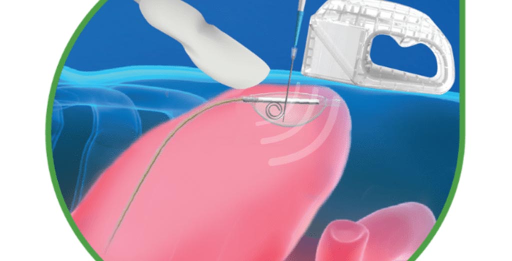 Imagen: El sistema PUMA-G proporciona un procedimiento de gastrostomía por ultrasonido percutáneo que se puede realizar rápida y fácilmente en los puntos de atención (Fotografía cortesía de CoapTech).