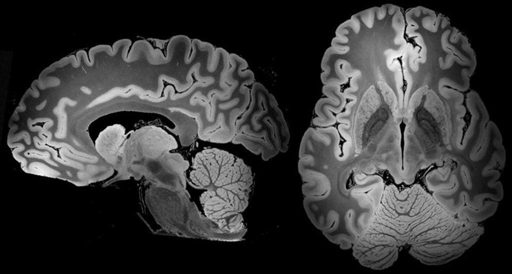 Imagen: Vistas de resonancia magnética de todo el cerebro humano (Fotografía cortesía de MGH).
