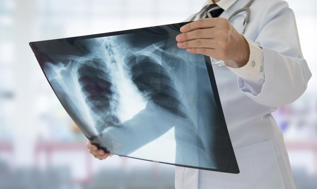 radiografía de cáncer de próstata
