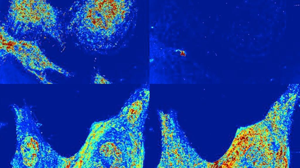 Imagen: Se observaron alteraciones en la estructura a nanoescala de células vivas utilizando microscopía óptica PWS (Fotografía cortesía de Vadim Backman/ NU).