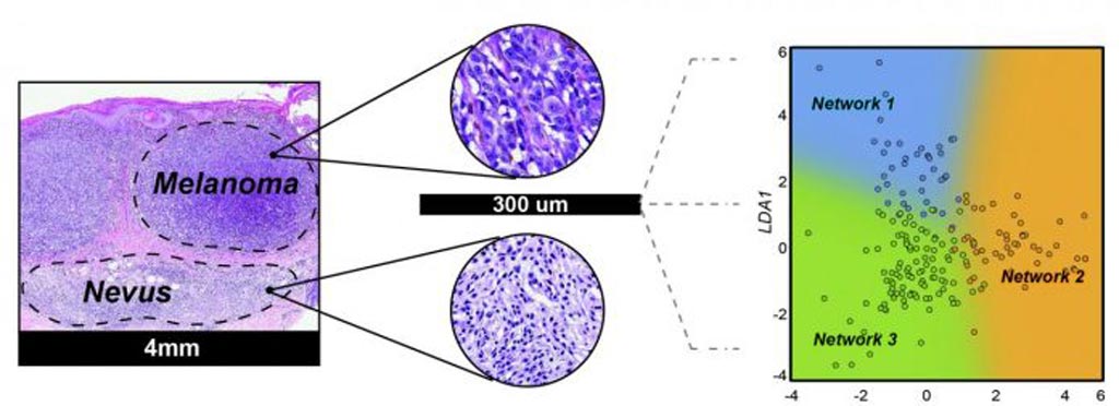 Imagen: La secuenciación de microARN y los algoritmos ópticos pueden detectar células de melanoma en los tumores de piel (Fotografía cortesía de Rodrigo Torres / UCSF).