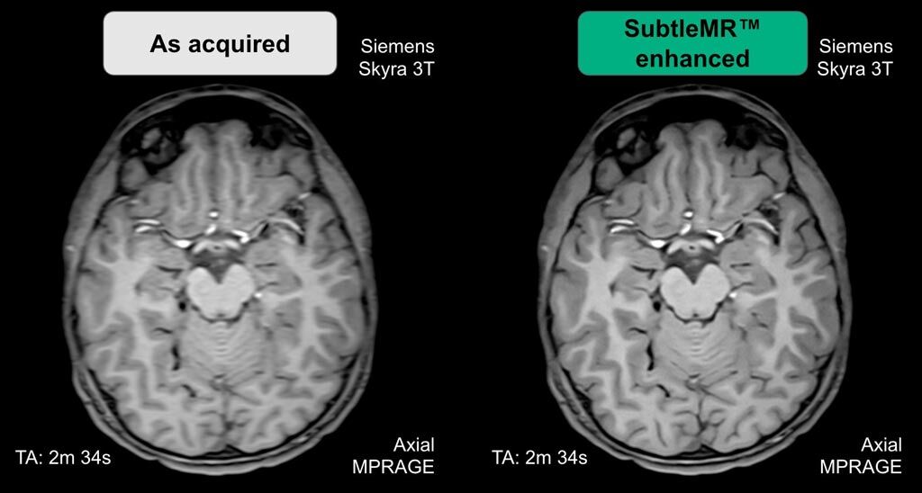 Imagen: SubtleMR con tecnología IA fue diseñado para mejorar las imágenes de la resonancia magnética (Fotografía cortesía de Subtle Medical).