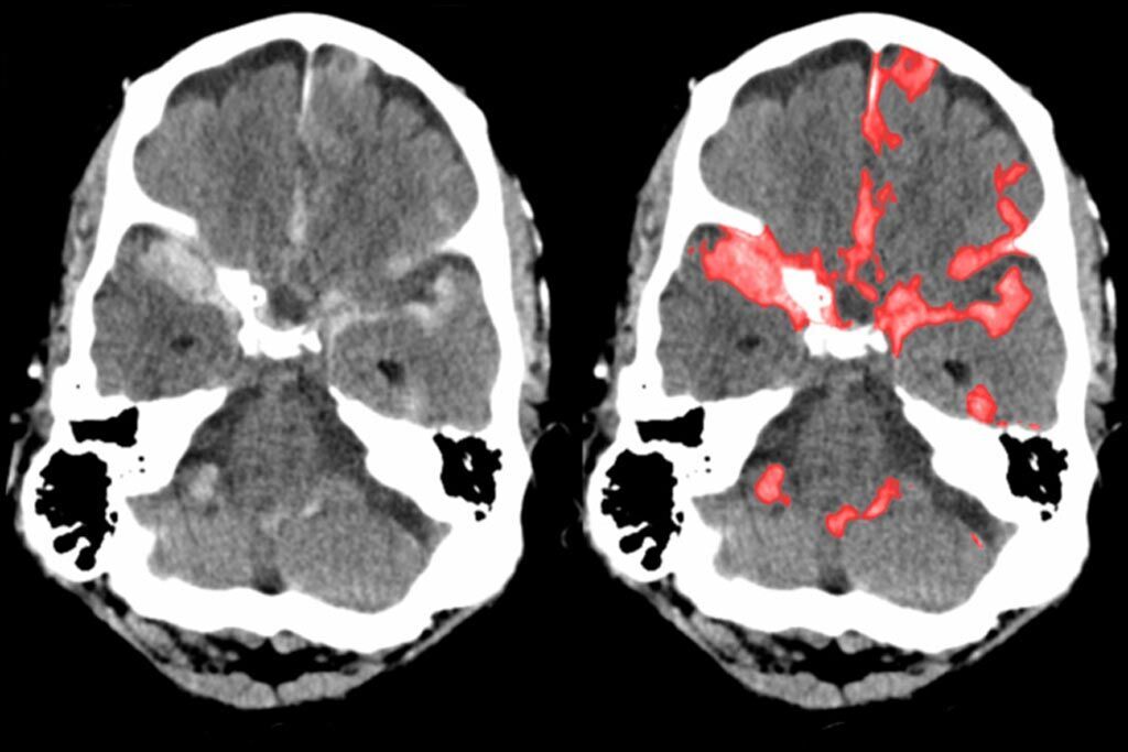 Imagen: Examen cerebral típico que un radiólogo ve (I), y una hemorragia subaracnoidea resaltada por PatchFCN (D) (Fotografía cortesía de la UCSF).