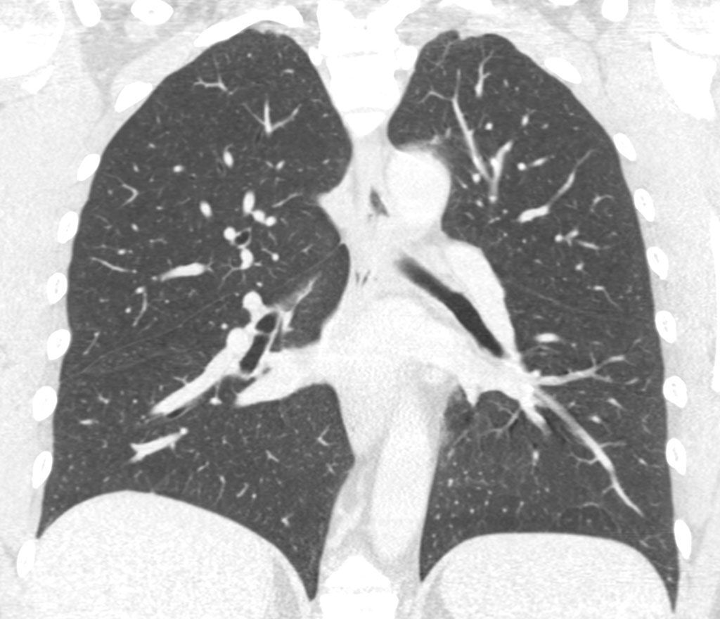 Imagen: Nódulos pulmonares indeterminados en una TC de pulmón (Fotografía cortesía de Optellum)