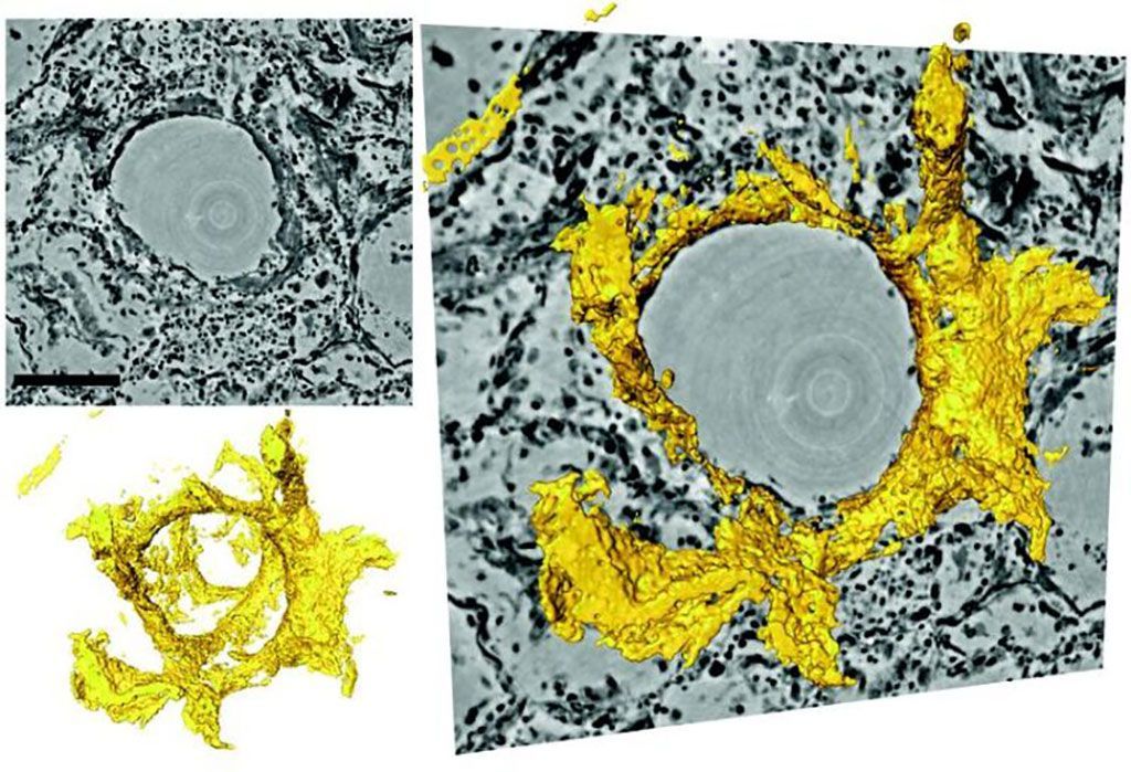 Imagen: Reconstrucción en 3D alrededor de un alvéolo pulmonar con membrana hialina (amarillo) (Fotografía cortesía de Tim Salditt/Universidad de Göttingen)