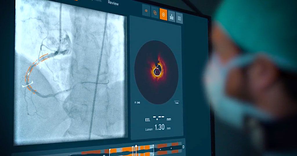 Imagen: El software Ultreon 1.0 mientras detecta calcificaciones de las arterias coronarias (Fotografía cortesía de Abbot)