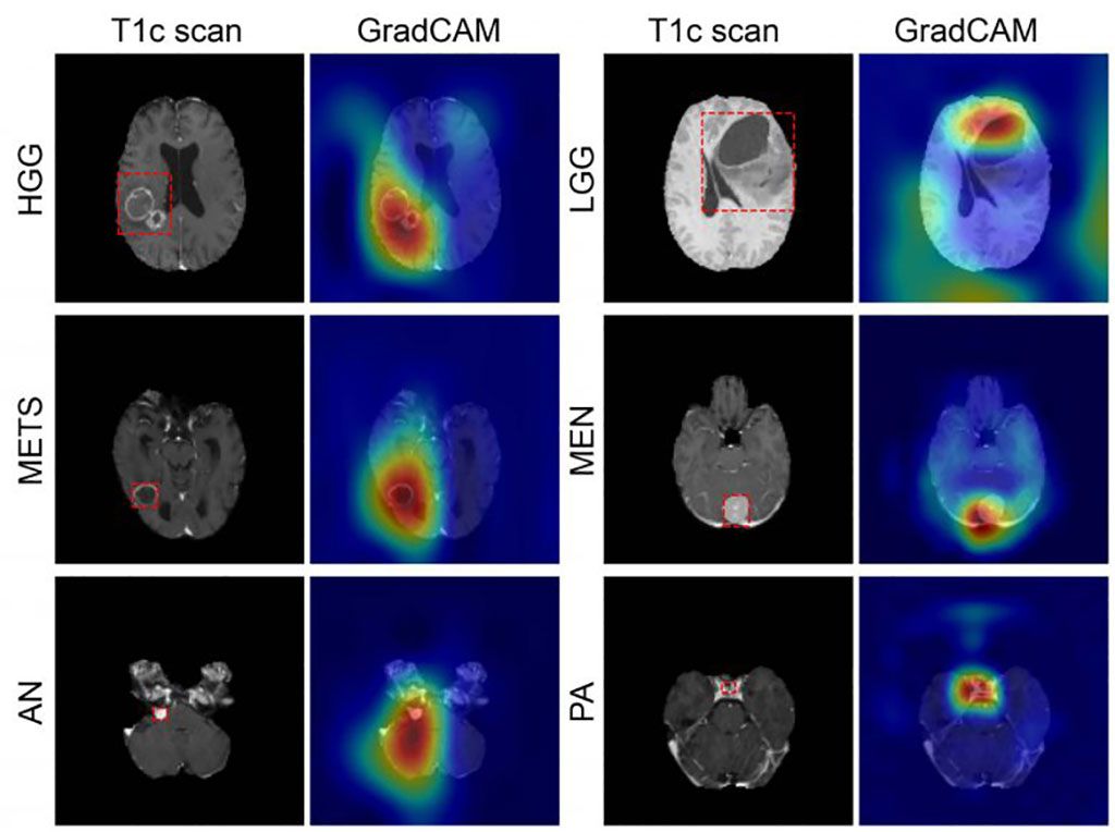 Imagen: Los colores de los mapas de color de GradCAM muestran la predicción de tumores (Fotografía cortesía de WUSTL)