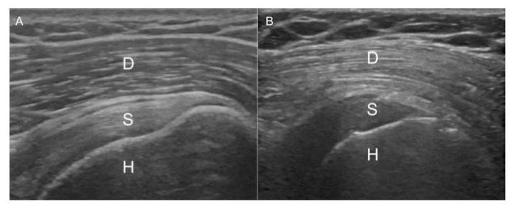 Imagen: Gradiente normal del músculo deltoides al tendón del supraespinoso (A) e inversión en un paciente con DT2 (D: deltoides, S: supraespinoso, H: húmero) (Fotografía cortesía de la RSNA)