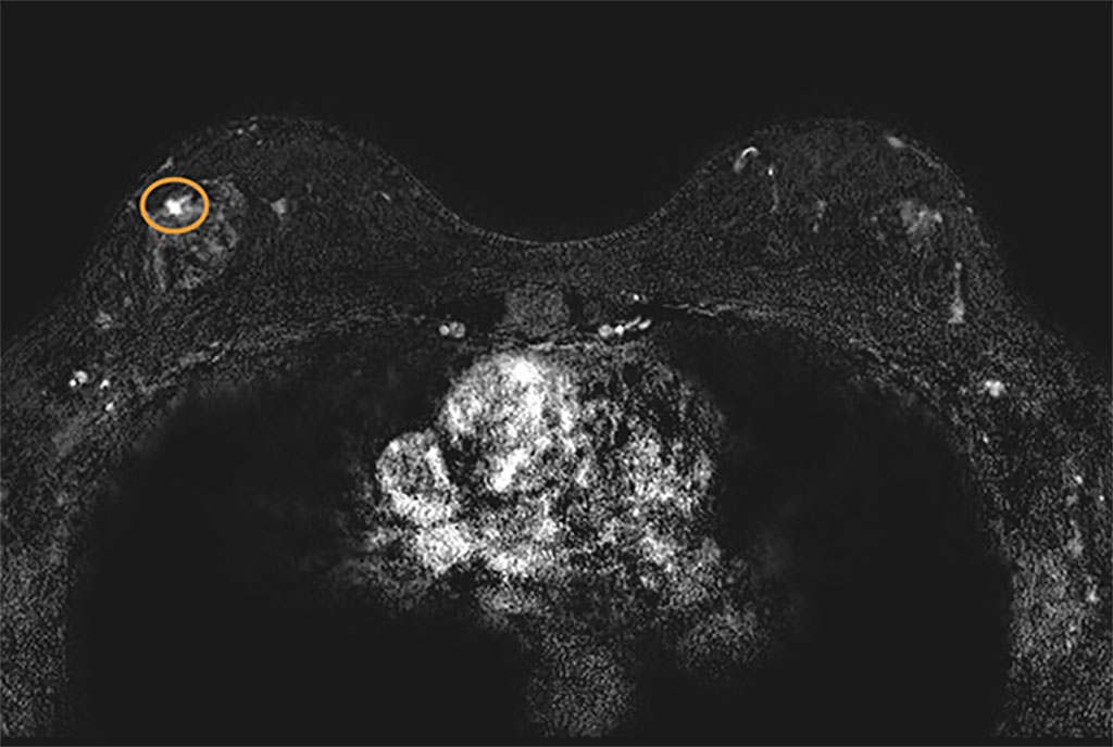 Imagen: La resonancia magnética de detección detecta un cáncer pequeño en el seno de una paciente (Fotografía cortesía de la Escuela de Medicina de la Universidad de Washington)