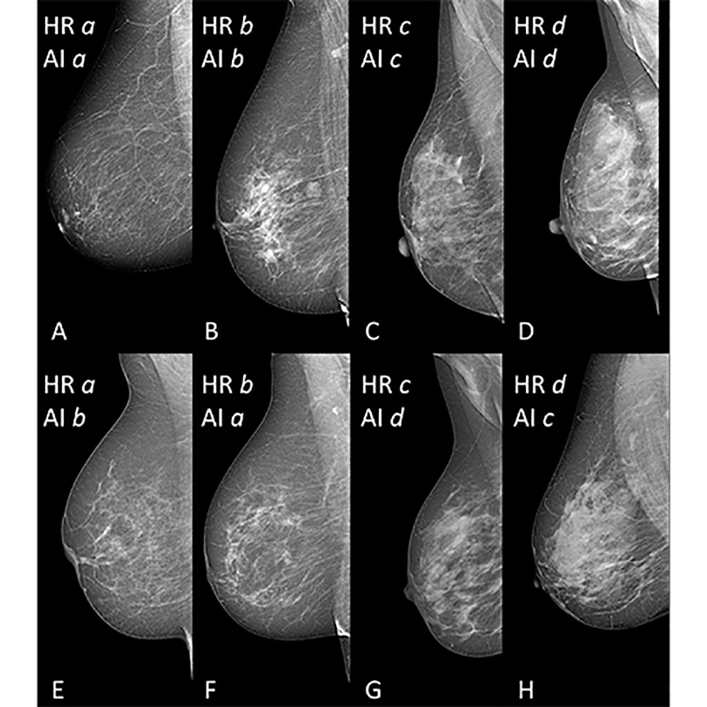 Imagen: Selección de vistas oblicuas mediolaterales mamográficas de senos con diferente densidad mamaria (Fotografía cortesía de RSNA)