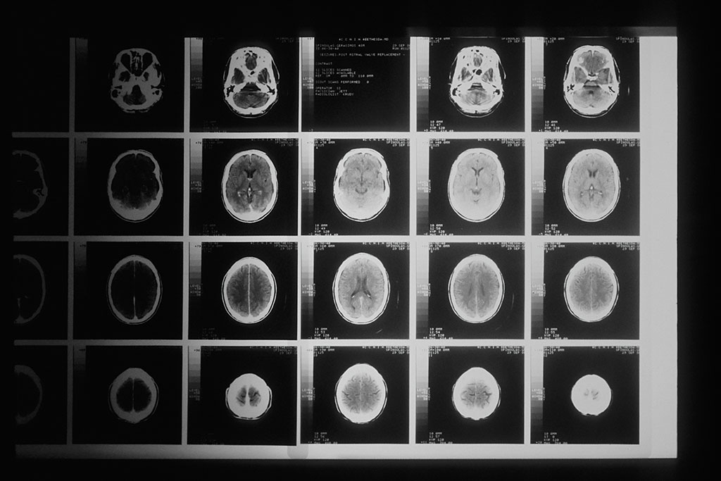 Imagen: La atrofia del tronco encefálico está relacionada con síntomas extrapiramidales en la demencia frontotemporal (Fotografía cortesía de Unsplash)