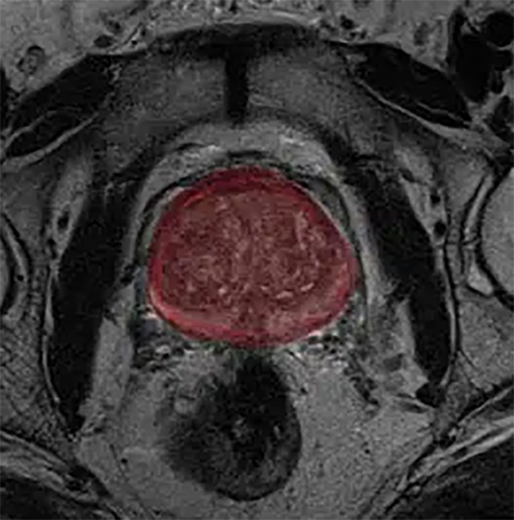 Imagen: Nueva herramienta de IA para el análisis de MRI de próstata para respaldar la puntuación PI-RADS (Fotografía cortesía de RSIP Vision)