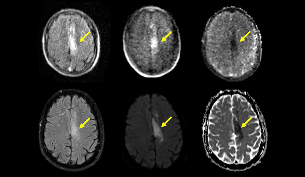Imagen: Resonancia magnética portátil (Fila superior) puede detectar y caracterizar el accidente cerebrovascular isquémico identificado por resonancia magnética estándar (fila inferior) (Fotografía cortesía de la Universidad de Yale)