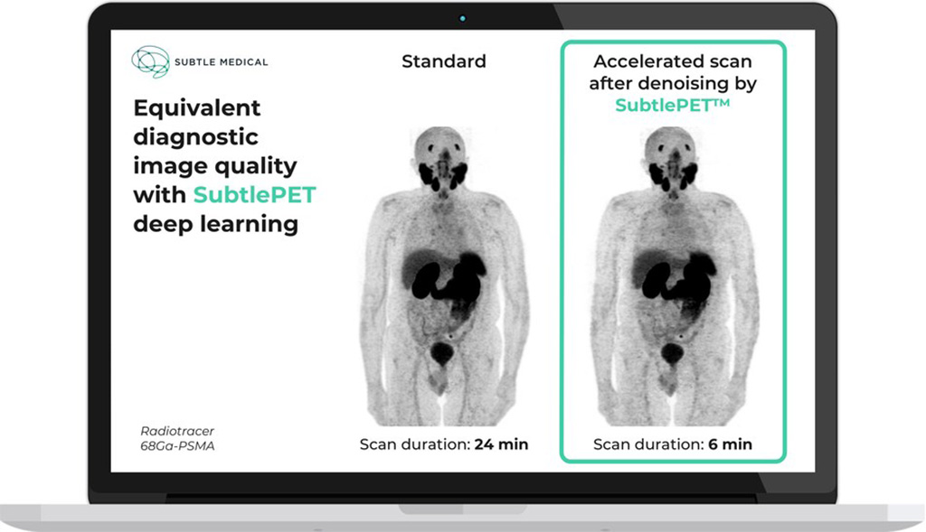 Imagen: Calidad de imagen de diagnóstico equivalente con Subtle PET AI (Fotografía cortesía de Subtle Medical)
