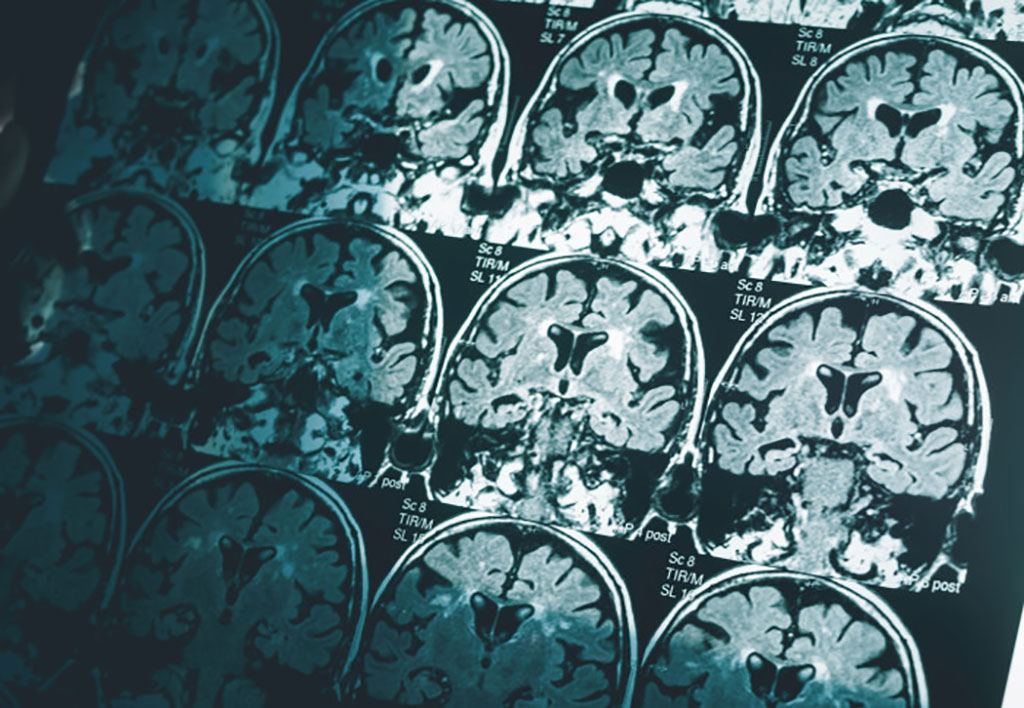 Imagen: Un solo escaneo cerebral puede diagnosticar la enfermedad de Alzheimer (Fotografía cortesía de Colegio Imperial)