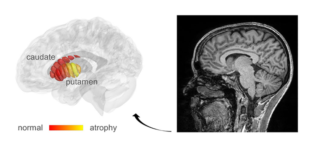 Imagen: Imágenes de resonancia magnética utilizadas para la detección automática de cambios microestructurales en pacientes de Parkinson en etapa temprana (Fotografía cortesía de la Universidad Hebrea)