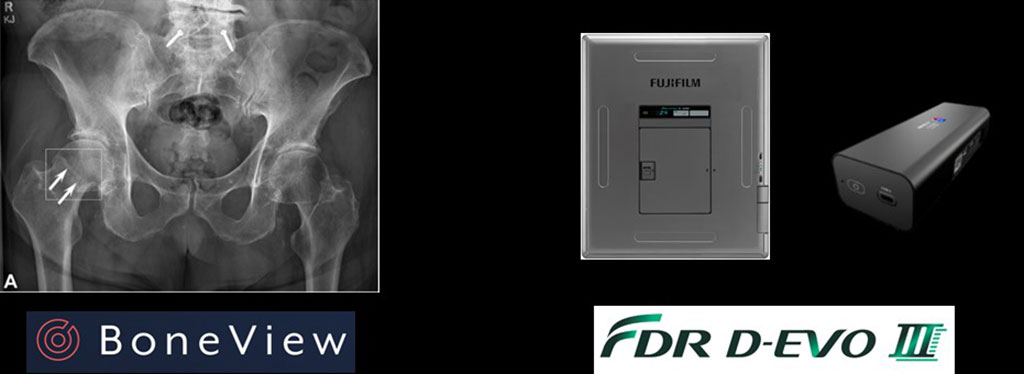Imagen: El software de IA Boneview se integrará con los sistemas de rayos X Fujifilm (Fotografía cortesía de Fujifilm)