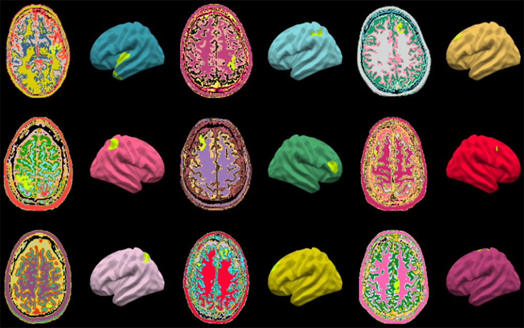 Imagen: Un algoritmo de IA detecta anomalías cerebrales sutiles que causan convulsiones epilépticas (Fotografía cortesía del Colegio Universitario de Londres)