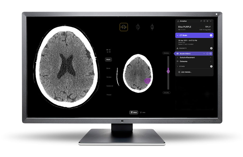 Imagen: El módulo Annalise Enterprise CTB ayuda a los radiólogos con la interpretación de estudios de imágenes radiológicas (Fotografía cortesía de Annalise)