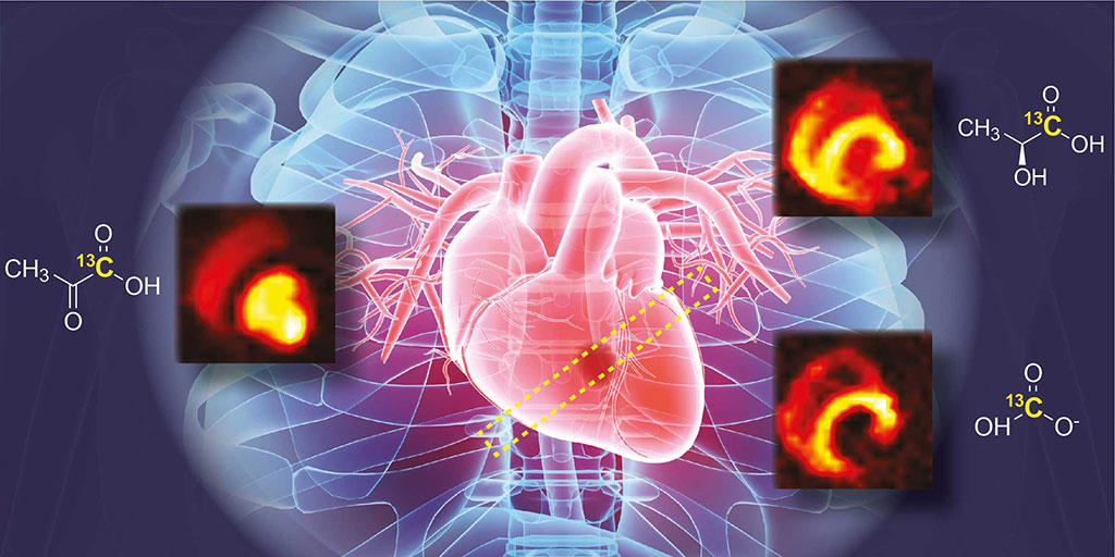 Imagen: La tecnología de resonancia magnética hiperpolarizada revela cambios en el metabolismo del azúcar del músculo cardíaco después de un ataque cardíaco (Fotografía cortesía de ETH Zurich)