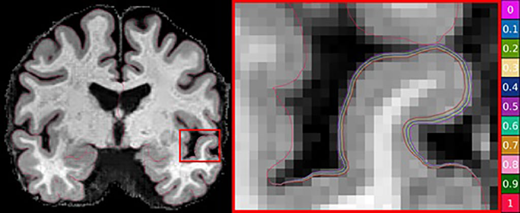 Imagen: Los investigadores han utilizado el aprendizaje automático para avanzar en la investigación de la enfermedad de Alzheimer (Fotografía cortesía de CSIRO)