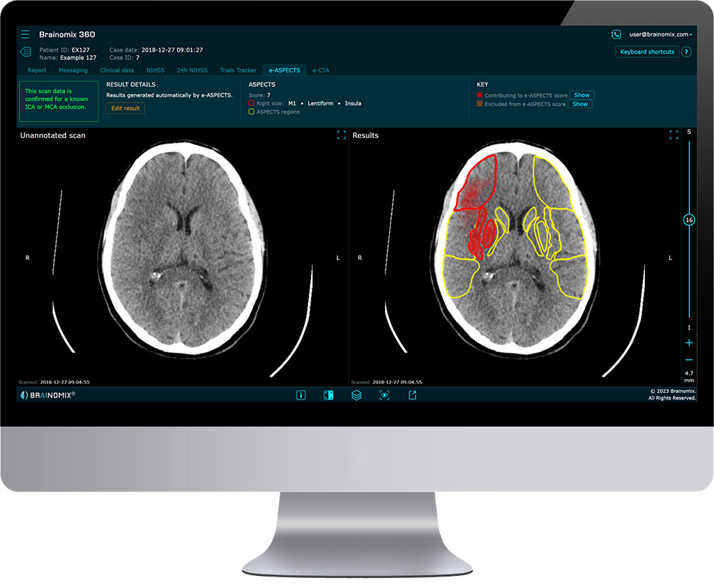 Imagen: El software de imágenes de accidente cerebrovascular con IA Brainomix 360 E-ASPECTS ha recibido la autorización de la FDA (Fotografía cortesía de Brainomix)