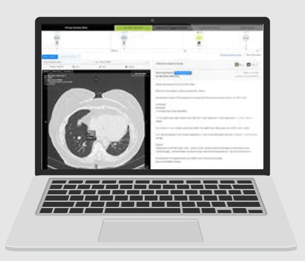 Imagen: Virtual Nodule Clinic faculta a los médicos para tomar decisiones clínicas óptimas en el diagnóstico de cáncer de pulmón en etapa temprana (Fotografía cortesía de Optellum)