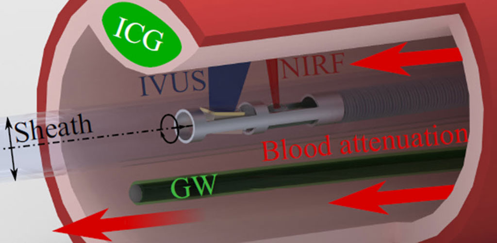 Imagen: Cable guía con cubrimiento de fluorescencia ayuda a la estimación precisa de la atenuación de la sangre durante los procedimientos intravasculares (Fotografía cortesía de TUM)