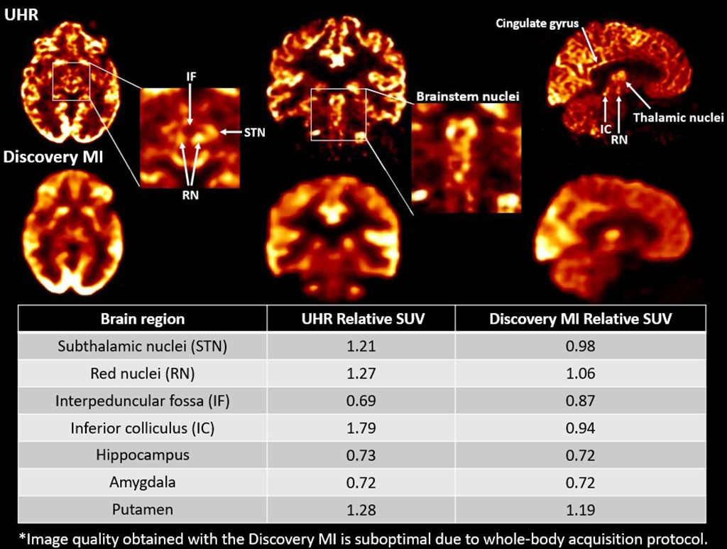 Imagen: Imágenes cerebrales de una mujer de 59 años adquirida usando el escáner UHR (arriba) y el Discovery MI Scanner (abajo) (Fotografía cortesía de la Universidad de Sherbrooke)