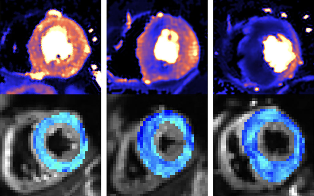 Imagen: Nuevos métodos de exploración pueden detectar miocardiopatía hipertrófica mortal antes de los síntomas (Fotografía cortesía de UCL)