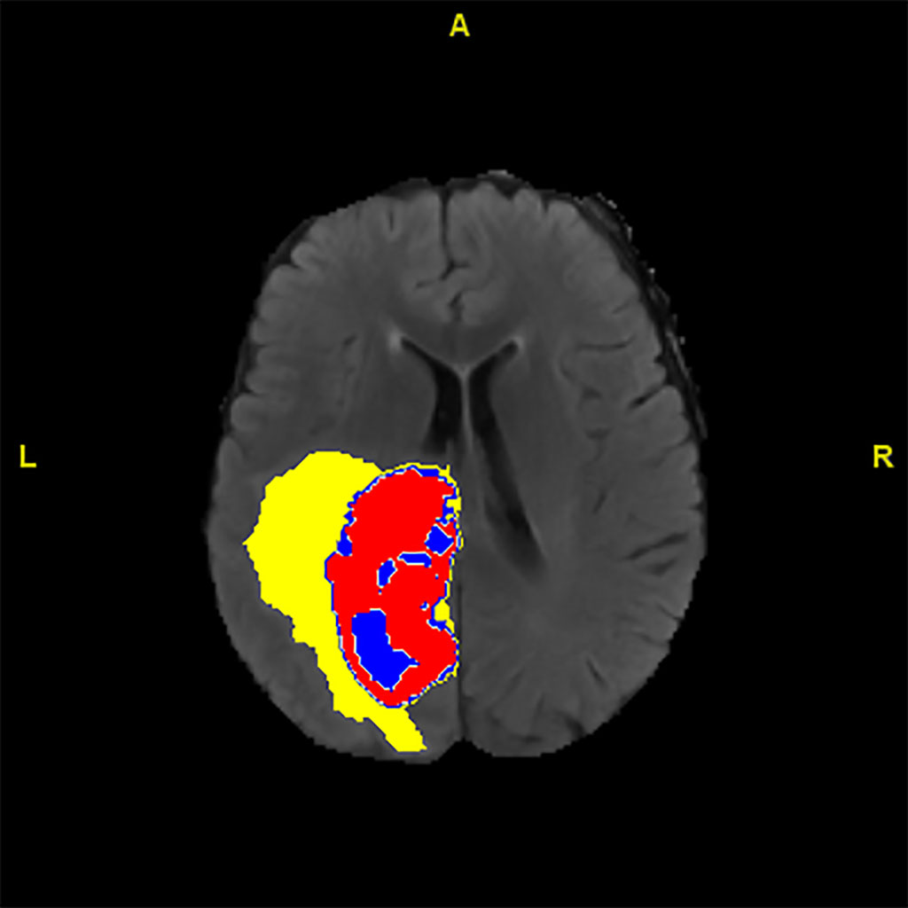 Imagen: Imagen médica anotada por IA que muestra regiones mejoradas de tumor, núcleo tumoral y edema (Fotografía cortesía de la Universidad de Monash)